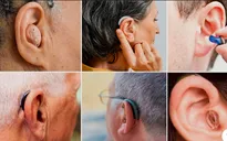 FDA Hoa Kỳ phê duyệt liệu pháp gene đầu tiên điều trị mất thính lực di truyền