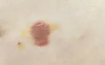 Cảnh giác bệnh chốc lở ở trẻ em mùa hè