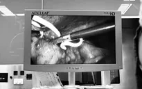 Dị vật "lạc chỗ" trong ổ bụng: Đừng chủ quan với những cơn đau kéo dài