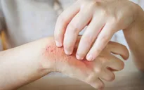Cách nhận biết và phòng tránh bệnh về da thường gặp mùa hè