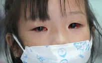 Bộ Y tế thông tin về bệnh do virus Adeno và bệnh đau mắt đỏ