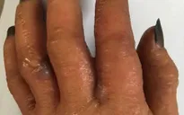 Cảnh giác viêm da tiếp xúc dị ứng do thuốc nhuộm tóc