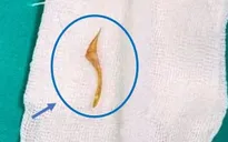 Cảnh báo dị vật tiêu hóa từ 3 ca cấp cứu liên tiếp