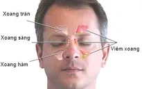 Thuốc điều trị viêm mũi xoang