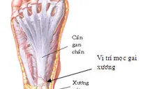 Không nên đi lại nhiều khi bị gai xương bàn chân