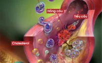 Lưu ý cho bệnh nhân rối loạn mỡ máu