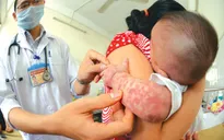 Đối tượng nào có nguy cơ mắc sởi?
