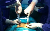 Phương pháp chữa liệt thành công bằng tế bào gốc