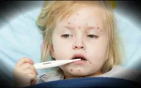 Mỹ công bố thêm 2 ca nhiễm sởi mới