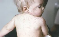 Mỹ: Số ca mắc sởi cao nhất trong vòng 18 năm