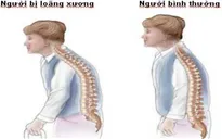 Phát hiện và phòng ngừa bệnh loãng xương ở phụ nữ