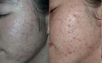 Cảnh báo corticoid trong mỹ phẩm