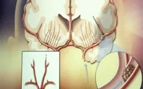 Trà thuốc cho người tăng huyết áp