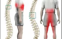 Dấu hiệu và các phương pháp điều trị thoát vị đĩa đệm