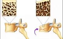 2,8 triệu người Việt Nam mắc bệnh loãng xương
