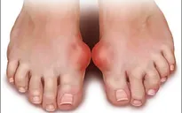 Bệnh Gout: Đâu là nguyên nhân?