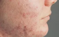 Điều trị bệnh viêm da dị ứng trong tiết giao mùa