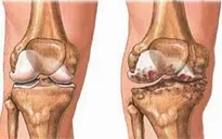 Phẫu thuật điều trị thoái hóa khớp, khi nào thì nên?