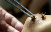 Liệu pháp chữa bệnh bằng ong đốt vẫn gây tranh cãi