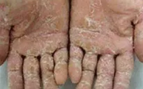 Hỗ trợ gạo cho tỉnh Quảng Ngãi khống chế "bệnh lạ"