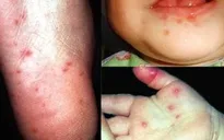 Bộ Y tế lập 5 đoàn kiểm tra bệnh tay chân miệng