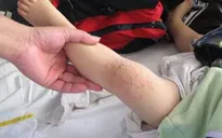 Bộ Y tế cảnh báo về bệnh tay chân miệng
