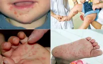 Nguy cơ bùng phát dịch bệnh tay chân miệng tại ĐBSCL