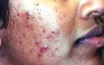 Cách điều trị mụn trứng cá