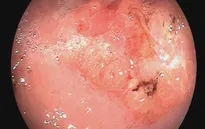 Đà Nẵng: Phẫu thuật nội soi thành công điều trị ung thư dạ dày
