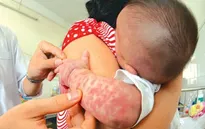 Cách phòng chống bệnh sởi trong mùa Đông Xuân