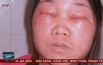 Sử dụng mỹ phẩm kém chất lượng, nạn nhân đối mặt với nỗi tuyệt vọng
