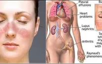 Bệnh nhân Lupus ban đỏ đa phần là nữ