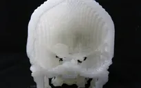 Công nghệ in 3D giúp phẫu thuật u não thành công