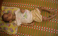 Mong manh sự sống của bé 2 tuổi 3 lần mổ não