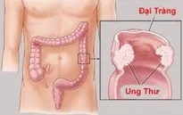 Phương pháp mới tiêu diệt tế bào ung thư đại trực tràng