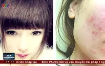 Nữ sinh viên bị nhiễm độc da, không được mang thai trong 1 năm vì hậu quả của mỹ phẩm