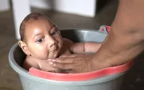 Thai nhi dị tật do virus Zika đầu tiên tại Mỹ