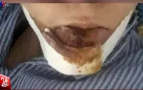Thanh tra việc nạn nhân phải cắt bỏ môi do biến chứng sau phẫu thuật thẩm mỹ