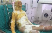 Hoàn cảnh đáng thương của cô công nhân may bị chồng thiêu sống