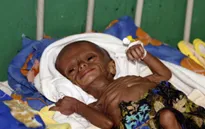 Gần 2,2 triệu trẻ em Yemen bị suy dinh dưỡng nặng