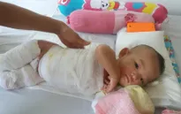 Thương cháu bé 11 tháng tuổi bị bỏng nước sôi nặng