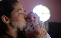 Brazil phát hiện virus Zika trong não của trẻ bị bệnh đầu nhỏ