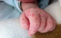 Đăk Lăk: Bé gái 4 tháng tuổi tử vong do nghi viêm màng não mô cầu