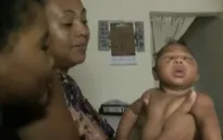 Thêm bằng chứng virus Zika liên quan tới dị tật đầu nhỏ