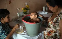 Nguy cơ trẻ bị dị tật đầu nhỏ lớn nếu mẹ nhiễm virus Zika trong 3 tháng đầu thai kỳ