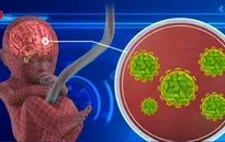 Thêm bằng chứng liên hệ virus Zika với rối loạn thần kinh