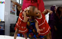 Cặp song sinh chào đời dính liền đầu tại Bangladesh