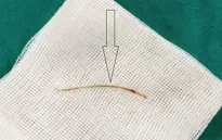 Đau bụng âm ỉ cả tuần, phát hiện do xương cá đâm thủng ruột