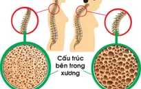 Loãng xương và chế độ dinh dưỡng phòng bệnh