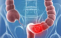 Những dạng ung thư không phải là án tử hình của cuộc đời